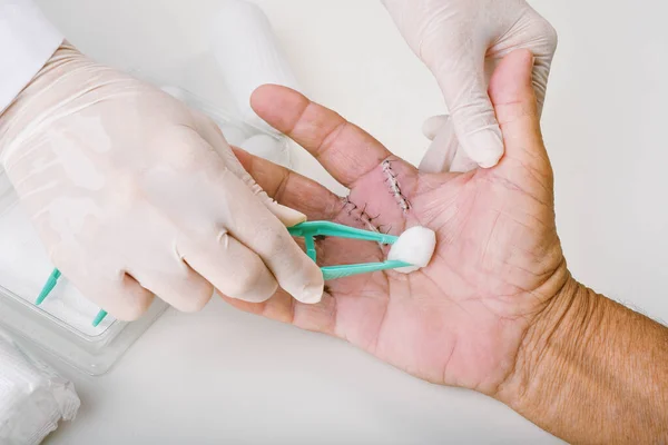 Doctor doing wound dressing care, Hand surgery treatment, Trigger finger stiffness painful, Doctor treat patient's hand injury in hospital, Wound stitches at index and middle finger.