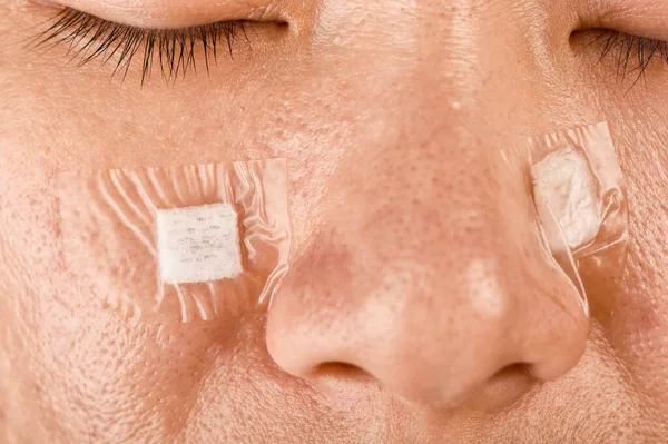 Cuidado Heridas Tratamiento Del Acné Curativo Cicatriz Facial Con Película — Foto de Stock
