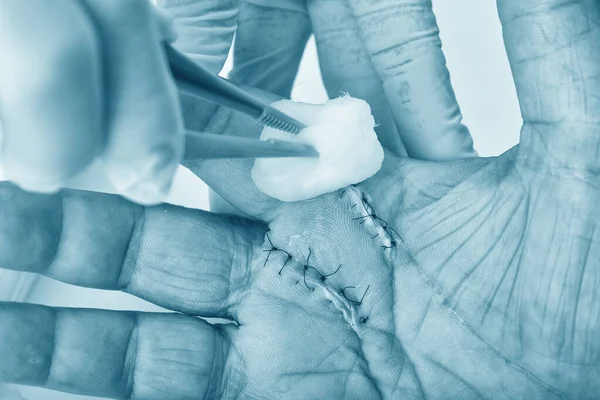 医生进行创面护理 手外科治疗 触发手指僵硬疼痛 医生在医院治疗病人手受伤 食指和中指伤口缝合 — 图库照片