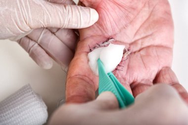 Doctor cleaning wound dressing care, Hand surgery treatment, Trigger finger stiffness painful, Doctor treat patient's hand injury in hospital, Wound stitches at index and middle finger.