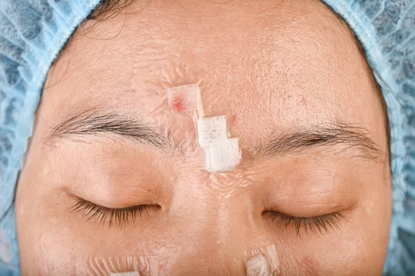 顔の皮膚の問題 大人のにきび病気 白い頭のにきびで女性の顔を閉じます 油性の顔 にきびレーザー治療後の発赤や腫れ傷 — ストック写真