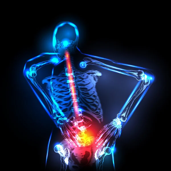 X 射线，背部疼痛，很容易在人类骨干可编辑 — 图库矢量图片#