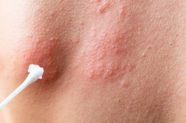 Deri döküntüleri için pamuklu bez. Zona, varisella-zoster virüsü. Vücudunda kızarıklık ve kabarcıklar var. Deri enfeksiyon kapmış Herpes zoster virüsü. Vücudunda uçuk virüsü var. ürtiker döküntüsü. atopik dermatit.