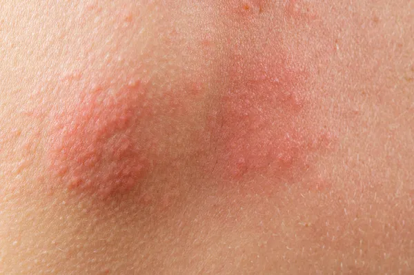 Chickenpox Rash Shingles Varicella Zoster Virus Skin Rash Blisters Body — Stock Photo, Image