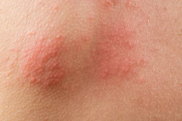 Erupción Varicela Culebrilla Virus Varicela Zóster Erupción Cutánea Ampollas Cuerpo — Foto de Stock