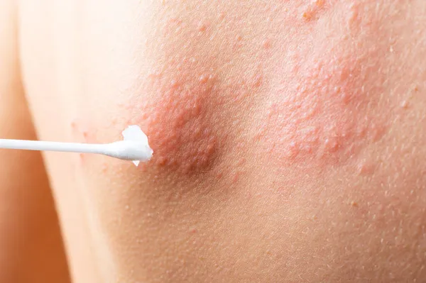 Cotton Swab Treatment Skin Rash Shingles Varicella Zoster Virus Skin — Stock Photo, Image