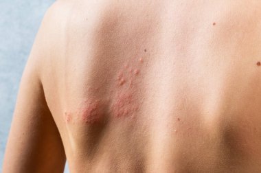 Suçiçeği kızarıklığı. Zona, varisella-zoster virüsü. Vücudunda kızarıklık ve kabarcıklar var. Deri enfeksiyon kapmış Herpes zoster virüsü. Vücudunda uçuk virüsü var. ürtiker döküntüsü. atopik dermatit.