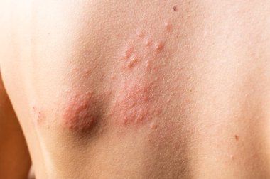 Suçiçeği kızarıklığı. Zona, varisella-zoster virüsü. Vücudunda kızarıklık ve kabarcıklar var. Deri enfeksiyon kapmış Herpes zoster virüsü. Vücudunda uçuk virüsü var. ürtiker döküntüsü. atopik dermatit.