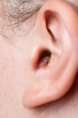 Close up of abscess Inflammation on the ear, area of suppuration. Ear furuncle. Purulent carbuncle. Treatment of abscess.
