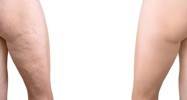 Gerilme izleri ve selülit çıkarma prosedüründen önce ve sonra kadınların kalça derisinin tahrip edilmesi