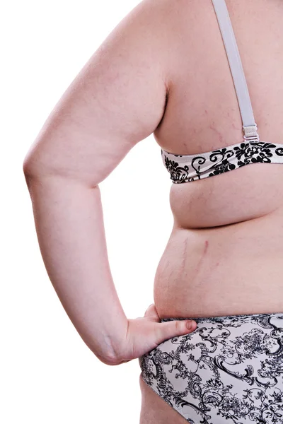 Szczegóły tułowia dziewczyna z cellulitem i otyłością — Zdjęcie stockowe