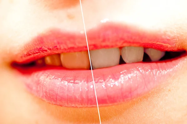 Donna denti prima e dopo lo sbiancamento . — Foto Stock