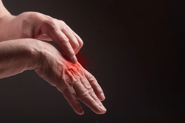 Senior hands. Suffering from pain and rheumatism — Stock Photo, Image