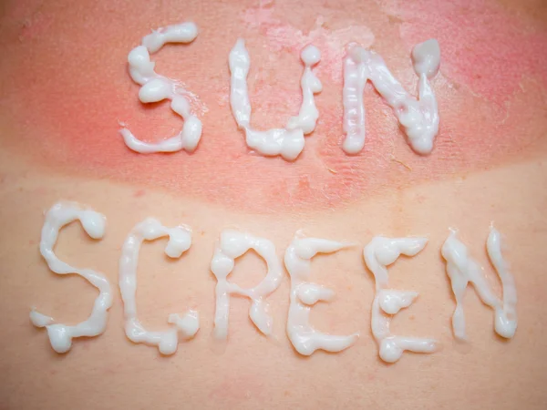 Sun screen burn — Stock Photo, Image