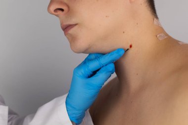 Nevus 'un çıkarılmasından sonra kalan yaranın yakın çekimi. İyi huylu deri lezyonlarının alınması ve tedavisi. Ameliyat mı? Doktor ve hasta tek atışta. Deri hastalığı tedavisi ve cerrahi bakım konsepti