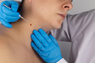 Nevus 'un çıkarılmasından sonra kalan yaranın yakın çekimi. İyi huylu deri lezyonlarının alınması ve tedavisi. Ameliyat mı? Doktor ve hasta tek atışta. Deri hastalığı tedavisi ve cerrahi bakım konsepti
