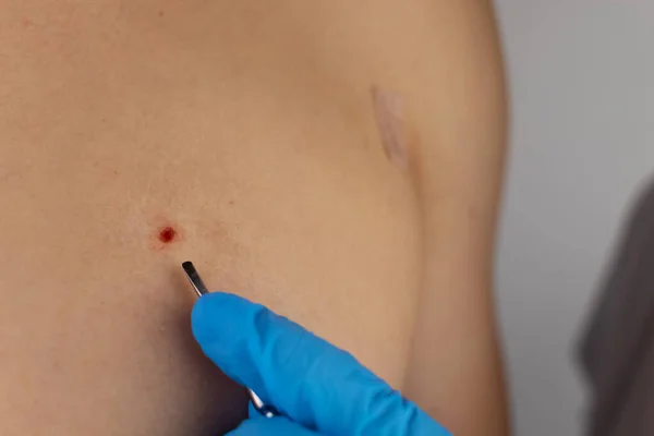 Közelkép Sebről Ami Nevus Kivágása Után Maradt Jóindulatú Bőrelváltozások Eltávolítása — Stock Fotó