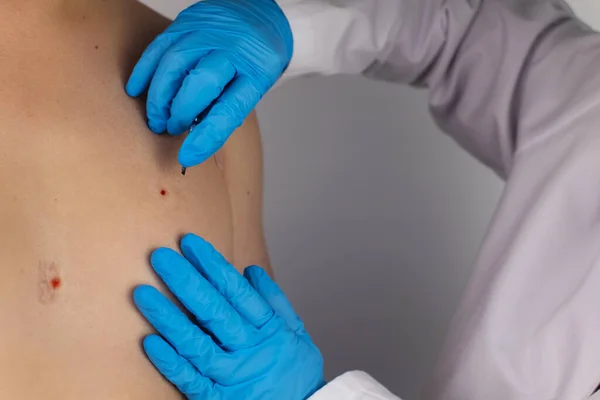 Közelkép Sebről Ami Nevus Kivágása Után Maradt Jóindulatú Bőrelváltozások Eltávolítása — Stock Fotó