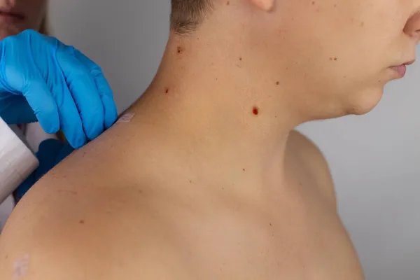 Close Van Wond Die Overbleef Uitsnijding Van Nevus Verwijdering Behandeling — Stockfoto