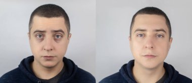 Önce ve sonra. Göz altı torbaları, erkek yüzünde fıtık. Hasta bir estetik cerrah tarafından muayene ediliyor. Kan alma ameliyatından önce ve sonra. Şişkinlik, deri kıvrımları ve göz kapaklarında varis damarları.