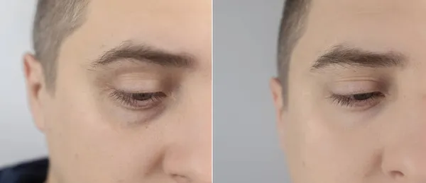 Antes Depois Sacos Sob Olhos Hérnias Rosto Homem Paciente Ser — Fotografia de Stock