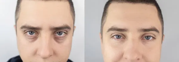 Antes Después Bolsas Bajo Los Ojos Hernias Cara Del Hombre — Foto de Stock