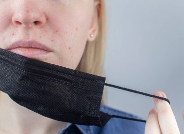 Kadın koruyucu maskeyi çıkarır ve yüz derisinde tahriş gösterir. Antiviral önlemler. Covid 19 'a karşı korunma aracı. Uzun zamandır maske takıyorum. Yüzünde sivilce ve aşınma. Kuru dudaklar ve kırmızı noktalar.