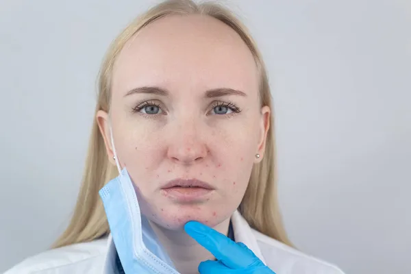 Médico Quita Máscara Protectora Muestra Irritación Piel Cara Medidas Antivirales — Foto de Stock
