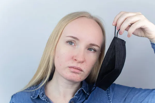 Vrouw Verwijdert Het Beschermende Masker Toont Irritatie Gezichtshuid Antivirale Maatregelen — Stockfoto