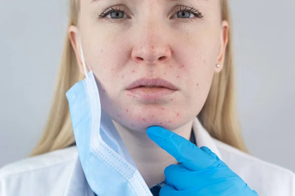 Doctor Removes Protective Mask Shows Irritation Face Skin Antiviral Measures — Stock Photo, Image