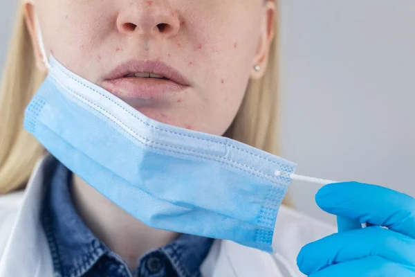 Γιατρός Αφαιρεί Την Προστατευτική Μάσκα Και Δείχνει Ερεθισμό Στο Δέρμα — Φωτογραφία Αρχείου