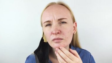 Kadın koruyucu maskeyi çıkarır ve yüz derisinde tahriş gösterir. Antiviral önlemler. Covid 19 'a karşı korunma aracı. Uzun zamandır maske takıyorum. Yüzünde sivilce ve aşınma. Kuru dudaklar ve kırmızı noktalar.