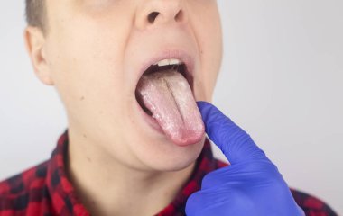 Dilinde beyaz kaymak. Bir doktor ya da gastroenterolog bir erkeğin dilini inceler. Hastanın ağız sağlığı ya da hastalık belirtileri zayıf. Gizli bir hastalığın belirtileri..