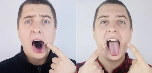 前後に 男の黒の舌のクローズアップ 言語ビロサの臨床症状 口の細菌感染症 強力な抗生物質を服用することの結果 真菌感染症 — ストック写真