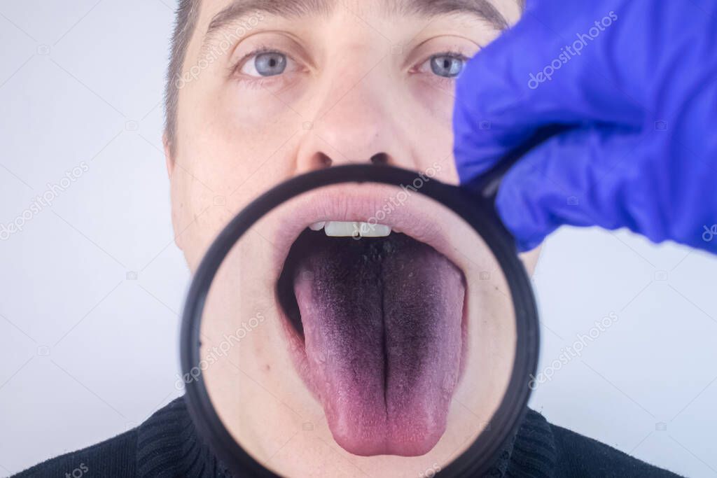 Close-up of a man black tongue. Clinical manifestations of lingua villosa. Bacterial infection of the mouth. The consequences of taking strong antibiotics. Fungal infection