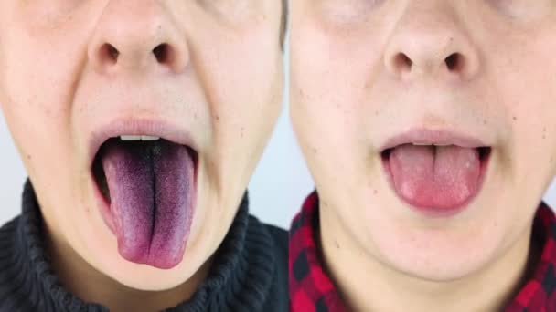 之前和之后 一个男人黑舌的特写 斜视语言障碍的临床表现 口腔细菌感染 服用强力抗生素的后果 真菌感染 — 图库视频影像