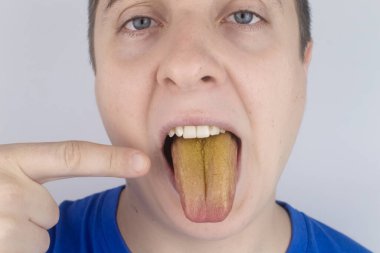 The man has a yellow tongue. Painful yellow coating on the mucous membrane of the tongue. Diseases of the gastrointestinal tract, liver and gallbladder. The consequences of taking antibiotics. clipart