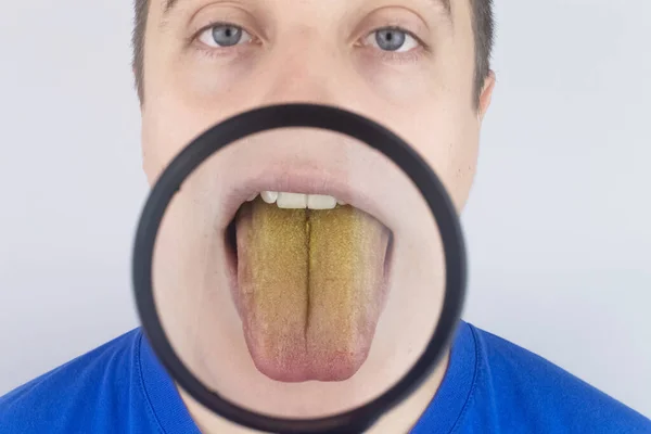 Homem Tem Uma Língua Amarela Revestimento Amarelo Doloroso Membrana Mucosa — Fotografia de Stock