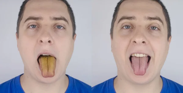 Man Has Yellow Tongue Painful Yellow Coating Mucous Membrane Tongue — Stock Photo, Image