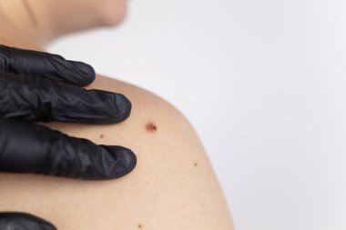 Dermatolog randevusundaki bir adam doğum lekelerini, benlerini ve nevi 'sini gösterir. Doktor dermatoskopla hastayı muayene ediyor. İyi huylu ve kötü huylu doğum lekeleri. Deri anormallikleri bakım konsepti