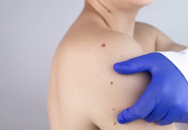Dermatolog randevusundaki bir adam doğum lekelerini, benlerini ve nevi 'sini gösterir. Doktor dermatoskopla hastayı muayene ediyor. İyi huylu ve kötü huylu doğum lekeleri. Deri anormallikleri bakım konsepti