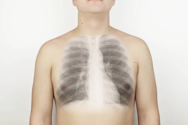 Kavramsal fotoğraf. Erkek göğüs röntgeni. Hastanın sırtında kaburga ve akciğerlerin bir görüntüsü belirdi. Derinin içindeki kemik görüntüsü. Gri arka planda yalnız bir adam..