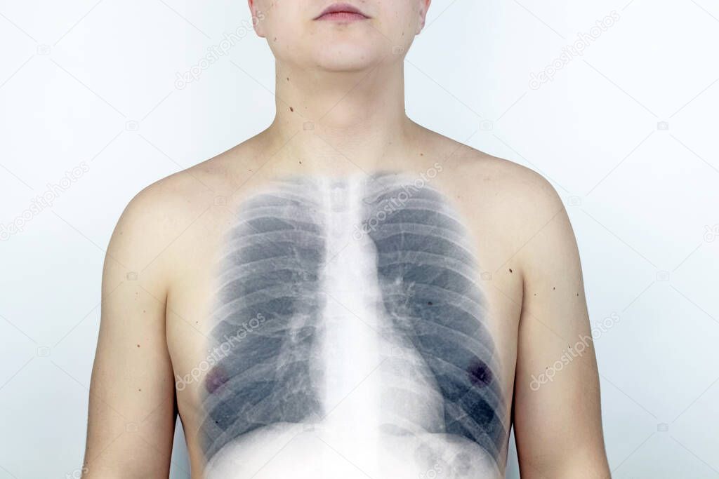 Conceptual photo. Male chest x-ray. An image of the ribs and lungs appeared on the skin of the patient back. View of bones through the skin. Isolated man on a gray background.