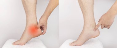 Önce ve sonra. Solda, bir adam ağrıyan topuğuna tutunuyor. Sağda, adamın ağrısı kayboldu ve doktorlar onu tedavi etti. Topuk kemiği, kas gerginliği, tendon hasarı veya mikro çatlaklar.