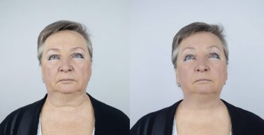 Second chin lift in senior woman. Photos before and after plastic surgery, mentoplasty or facebuilding. Chin fat removal and face contour correction. Face lifting from elderly female clipart