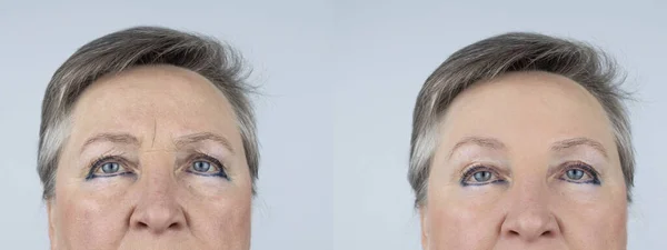 Forehead Keriput Foto Sebelum Dan Sesudah Mesoterapi Biorevitalisasi Suntikan Racun — Stok Foto