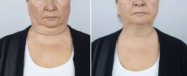 Photos before and after plastic surgery to remove Venus rings. Contour plastics of the neck, mesotherapy or botulinum therapy. Wrinkles and creases in the neck