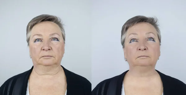 Second chin lift in senior woman. Photos before and after plastic surgery, mentoplasty or facebuilding. Chin fat removal and face contour correction. Face lifting from elderly female