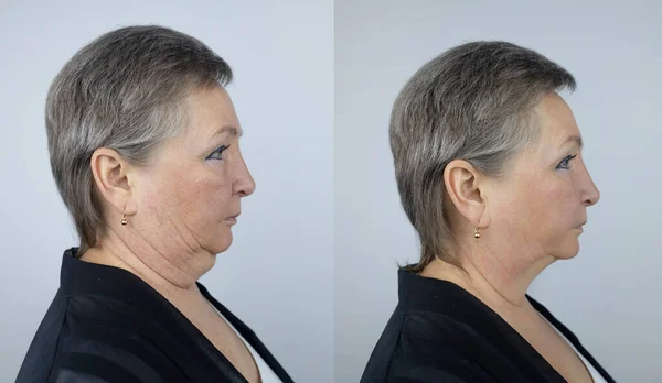 シニア女性で2本目の顎持ち上げ 形成外科手術前と後の写真 造形や顔の建物 チン脂肪除去と顔輪郭補正 高齢女性から顔を持ち上げる — ストック写真