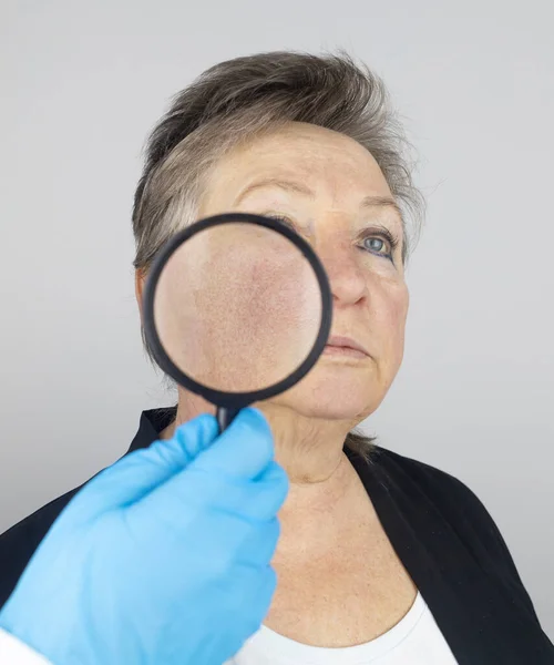 Rosacea Huid Van Een Oude Vrouw Close Van Een Capillair — Stockfoto